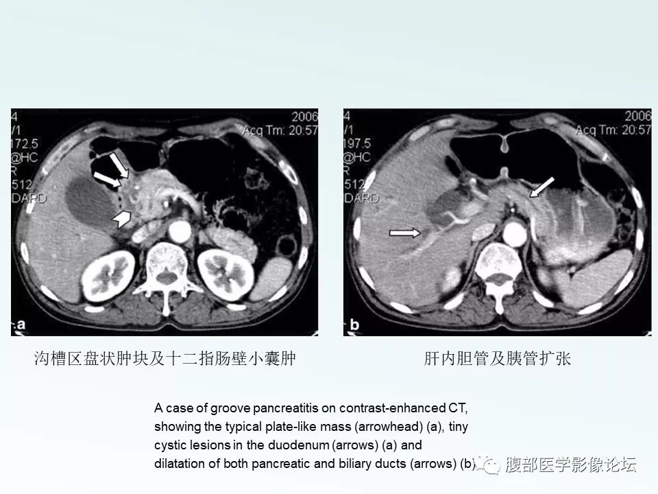 【PPT】沟槽性胰腺炎