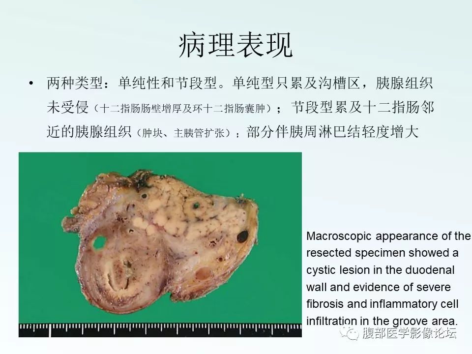 【PPT】沟槽性胰腺炎