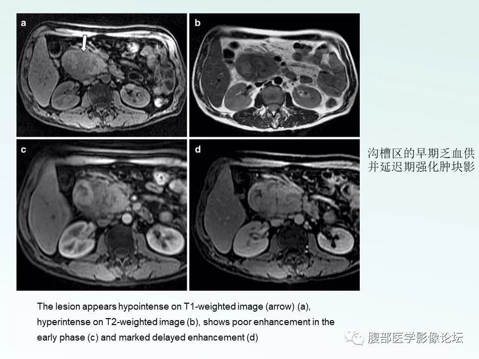 【PPT】沟槽性胰腺炎