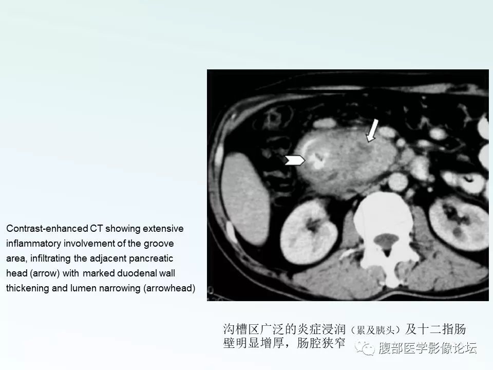 【PPT】沟槽性胰腺炎