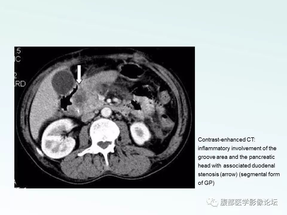 【PPT】沟槽性胰腺炎