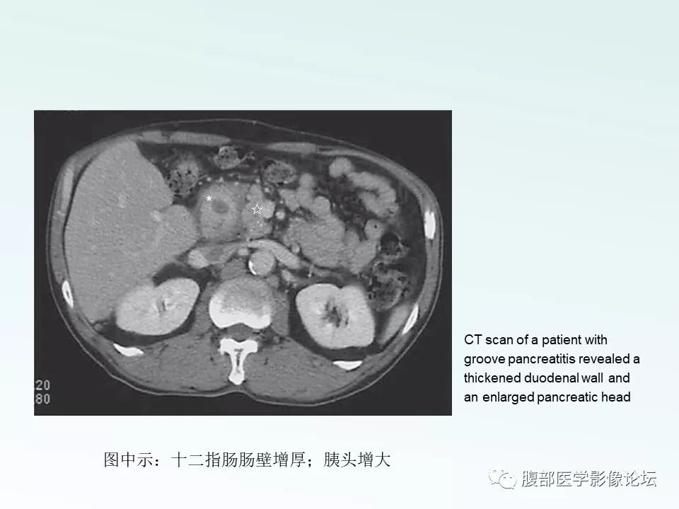 【PPT】沟槽性胰腺炎