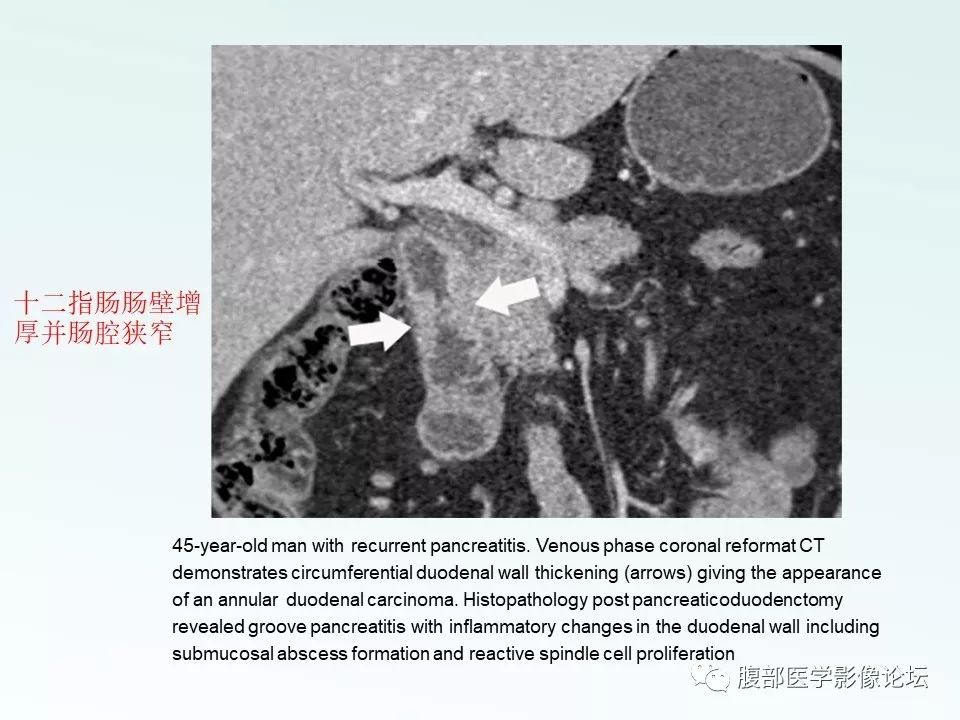 【PPT】沟槽性胰腺炎
