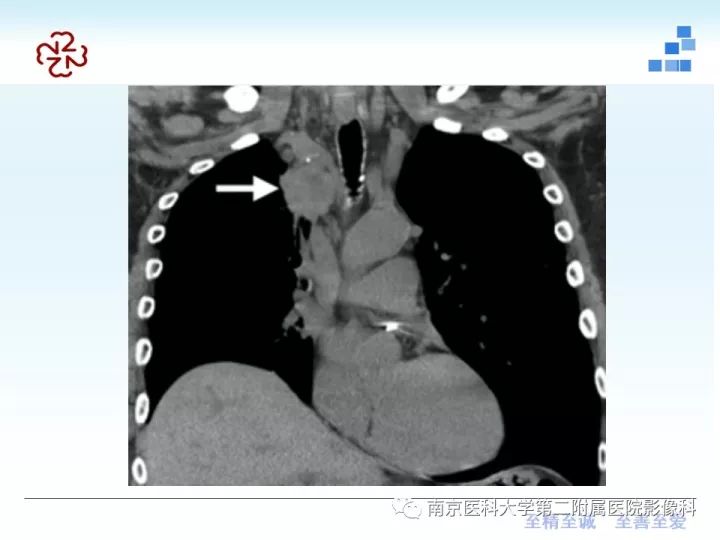 【PPT】膈肌的解剖及病变