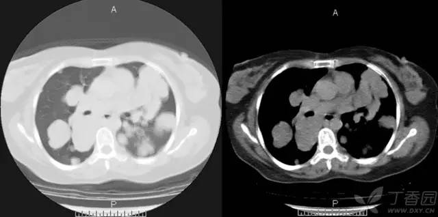 【病例】肺转移性腺样囊性癌1例
