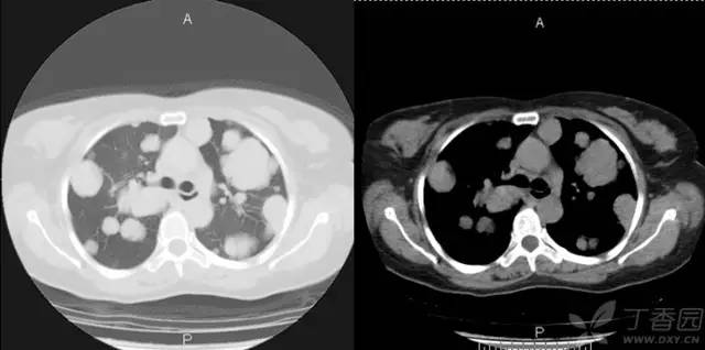 【病例】肺转移性腺样囊性癌1例