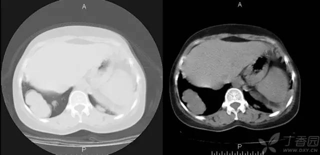 【病例】肺转移性腺样囊性癌1例 【病例】肺转移性腺样囊性癌1例