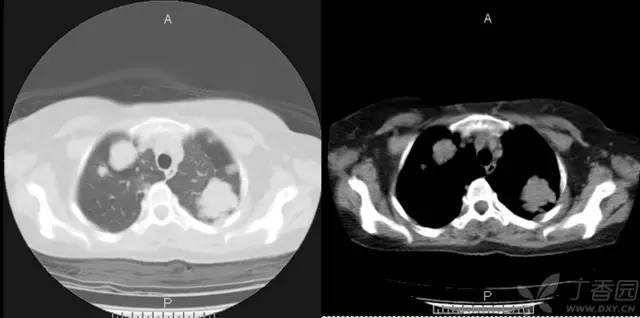 【病例】肺转移性腺样囊性癌1例