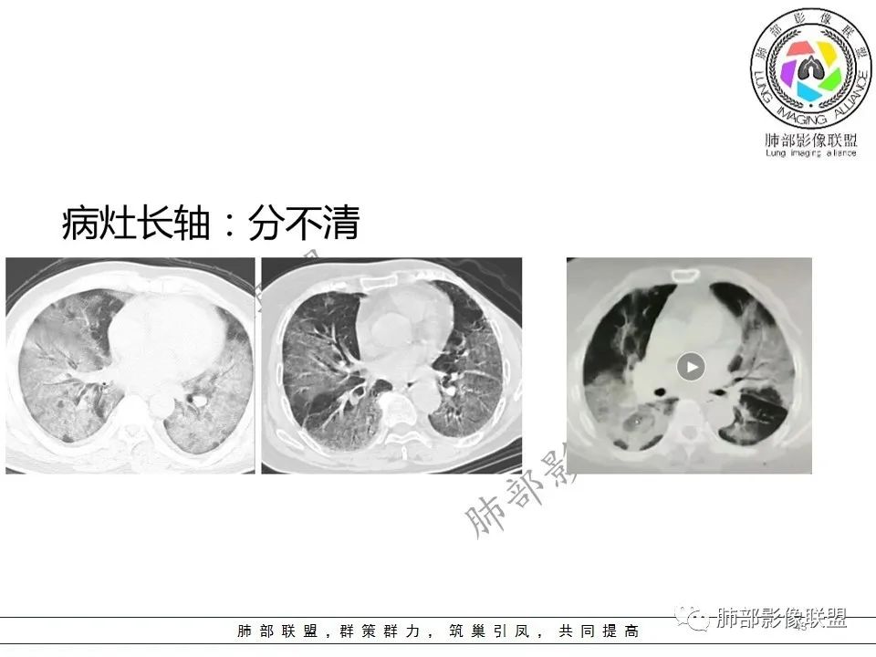 【PPT】关于180余例新冠肺炎(NCP)的影像分析与思考