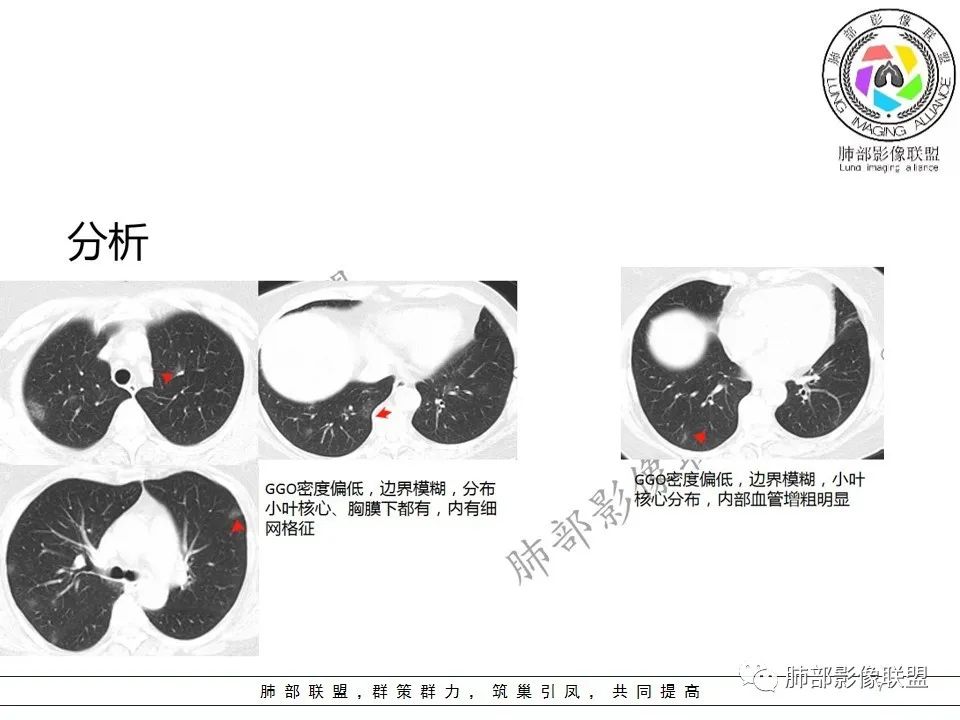【PPT】关于180余例新冠肺炎(NCP)的影像分析与思考