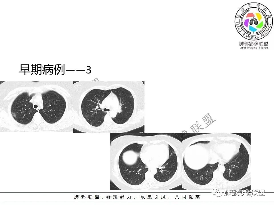 【PPT】关于180余例新冠肺炎(NCP)的影像分析与思考
