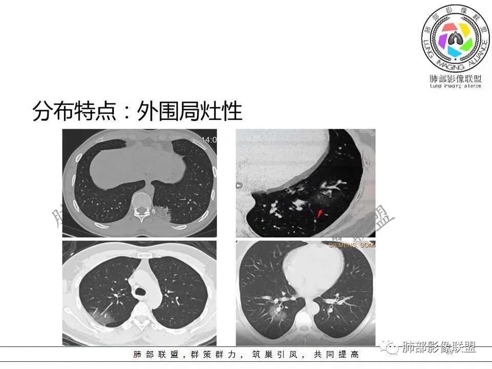 【PPT】关于180余例新冠肺炎(NCP)的影像分析与思考