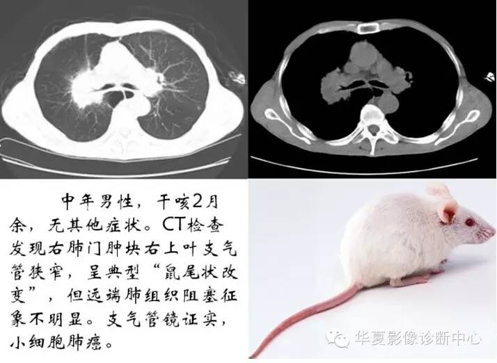 呼吸系统33个影像征象