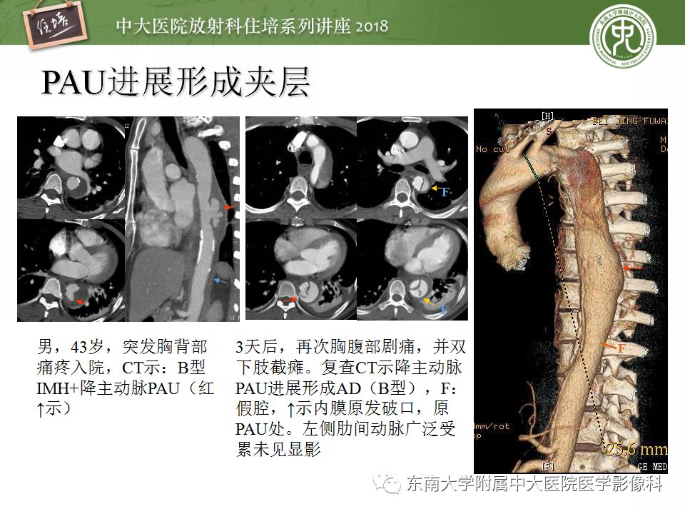 【PPT】急性主动脉综合征的CTA诊断与高风险征象