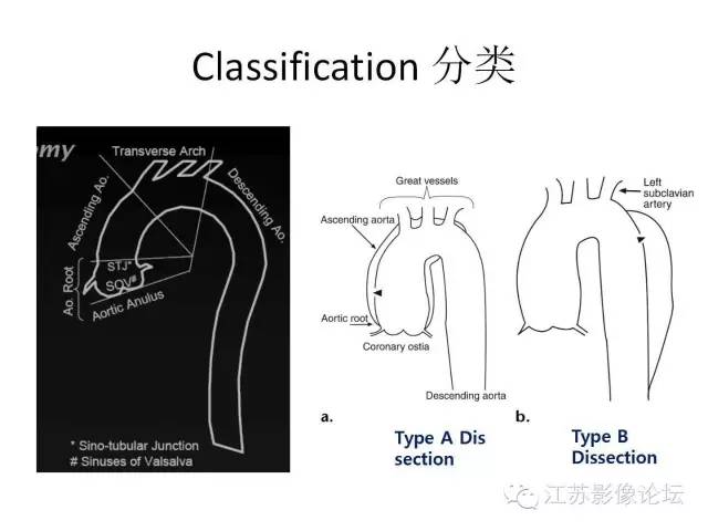 【PPT】急诊室经常遇到的急性主动脉疾病
