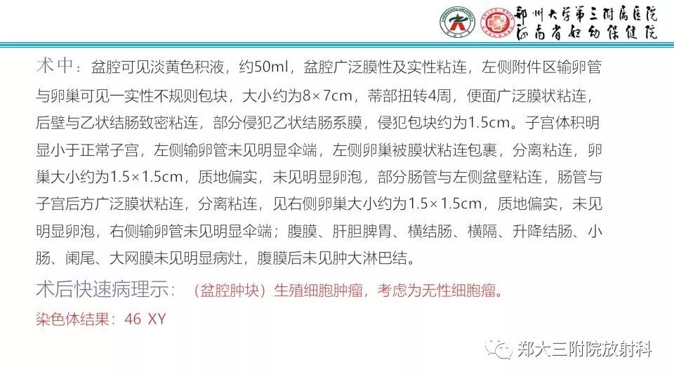 【病例】卵巢无性细胞瘤1例MR影像 【病例】卵巢无性细胞瘤1例MR影像