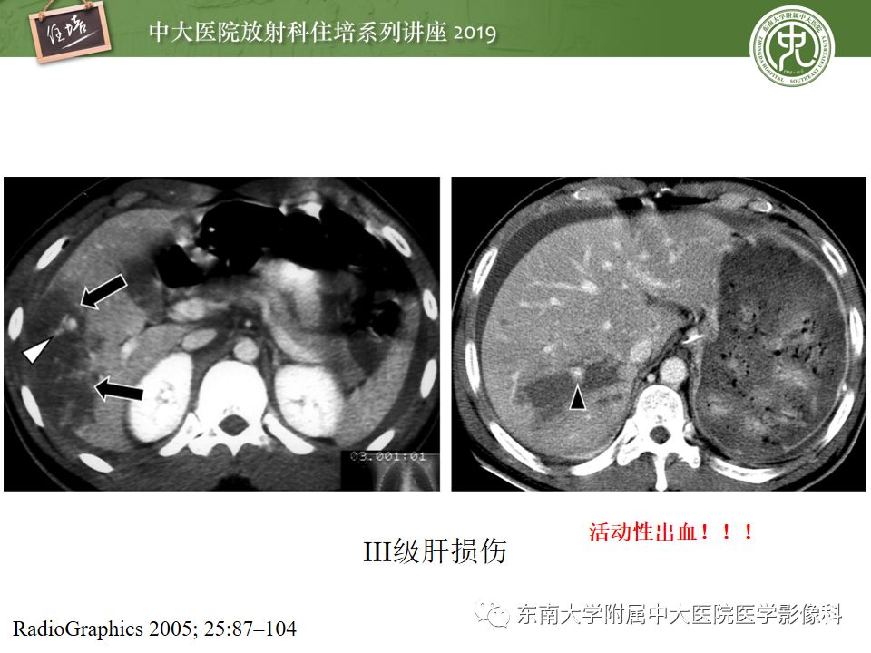 【PPT】腹腔实性脏器钝性外伤影像诊断