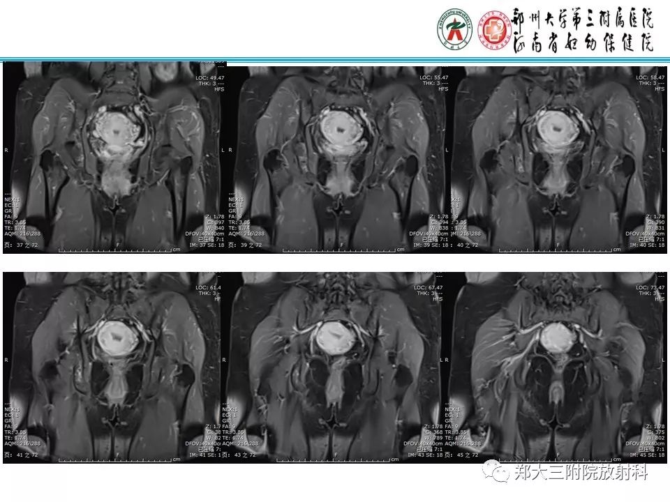【病例】子宫静脉内平滑肌瘤病1例MR影像