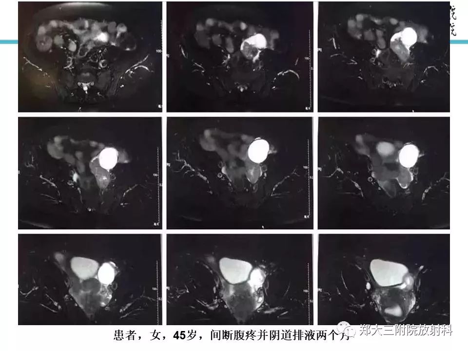 【病例】子宫静脉内平滑肌瘤病1例MR影像