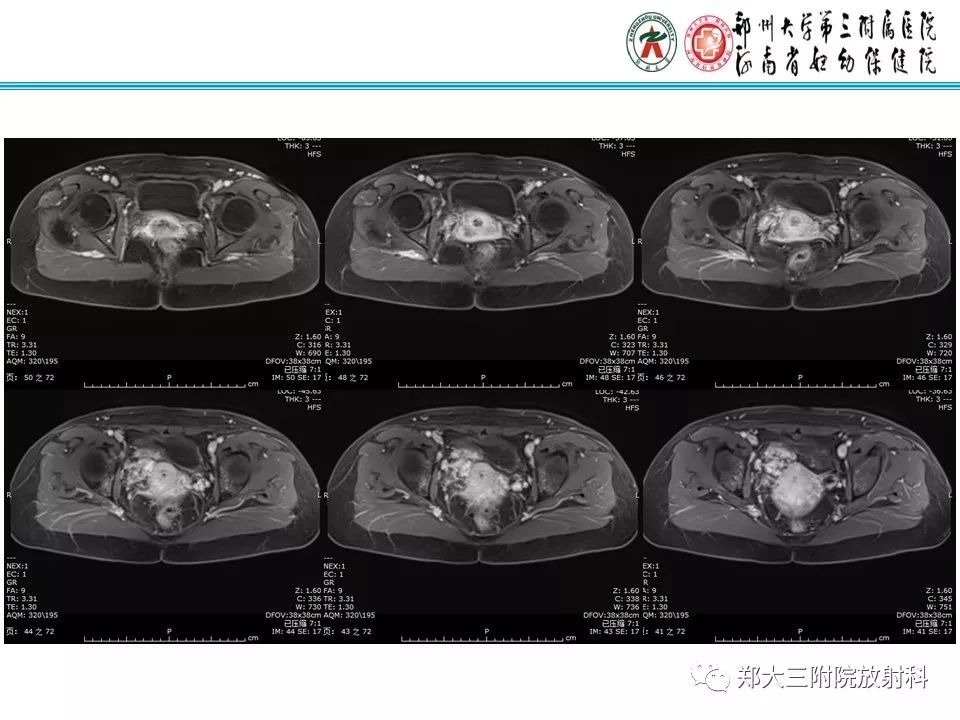 【病例】子宫静脉内平滑肌瘤病1例MR影像