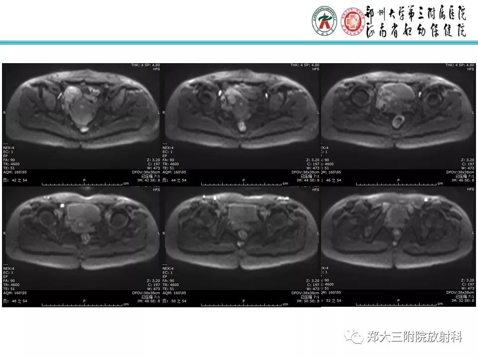 【病例】子宫静脉内平滑肌瘤病1例MR影像