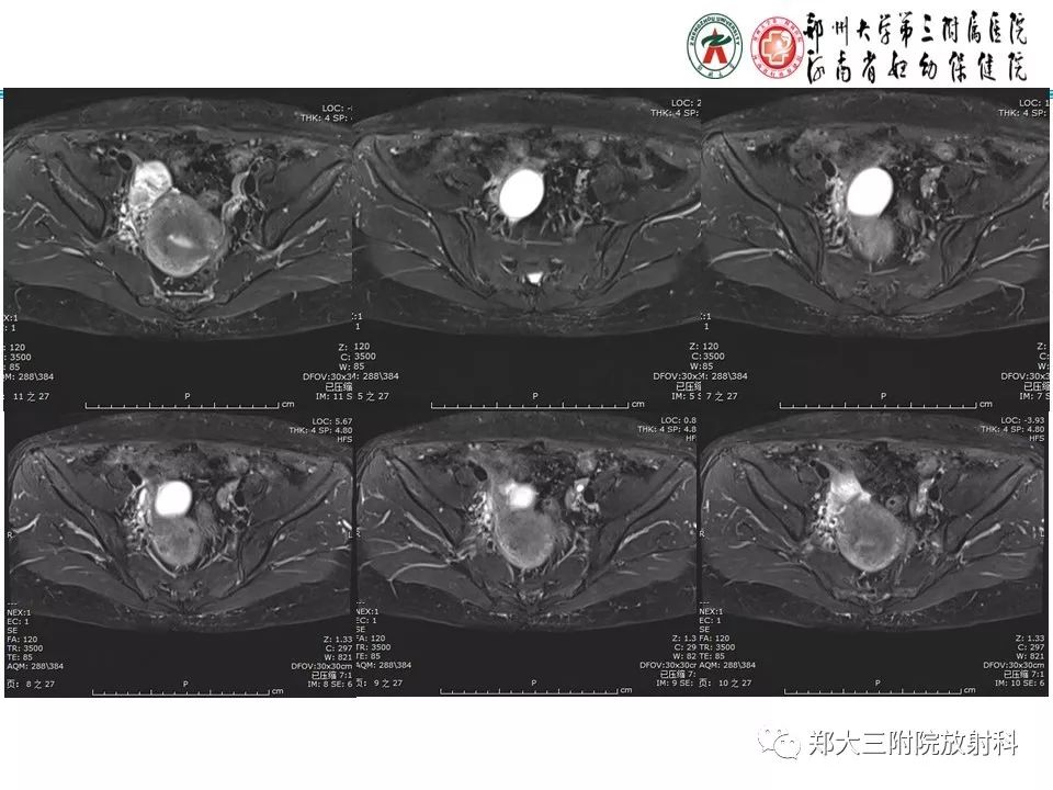 【病例】子宫静脉内平滑肌瘤病1例MR影像
