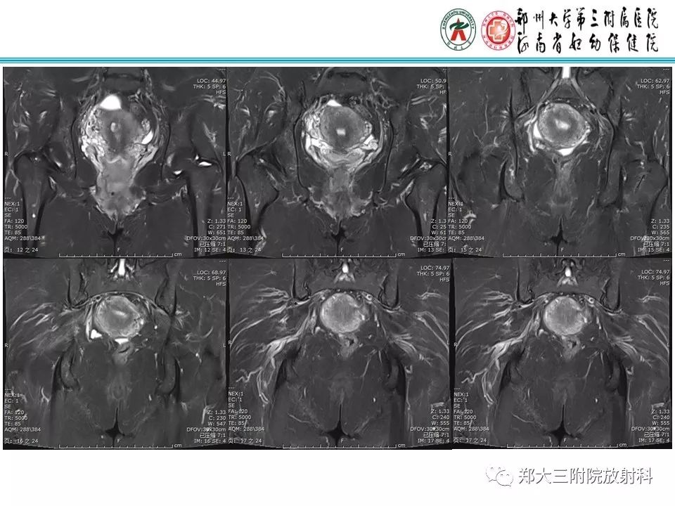 【病例】子宫静脉内平滑肌瘤病1例MR影像