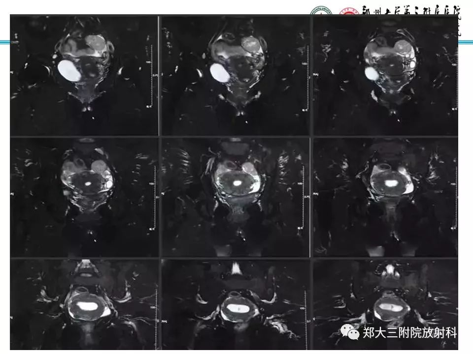 【病例】子宫静脉内平滑肌瘤病1例MR影像