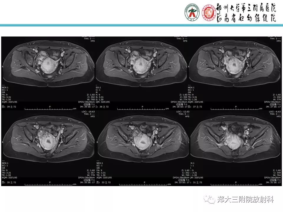【病例】子宫静脉内平滑肌瘤病1例MR影像