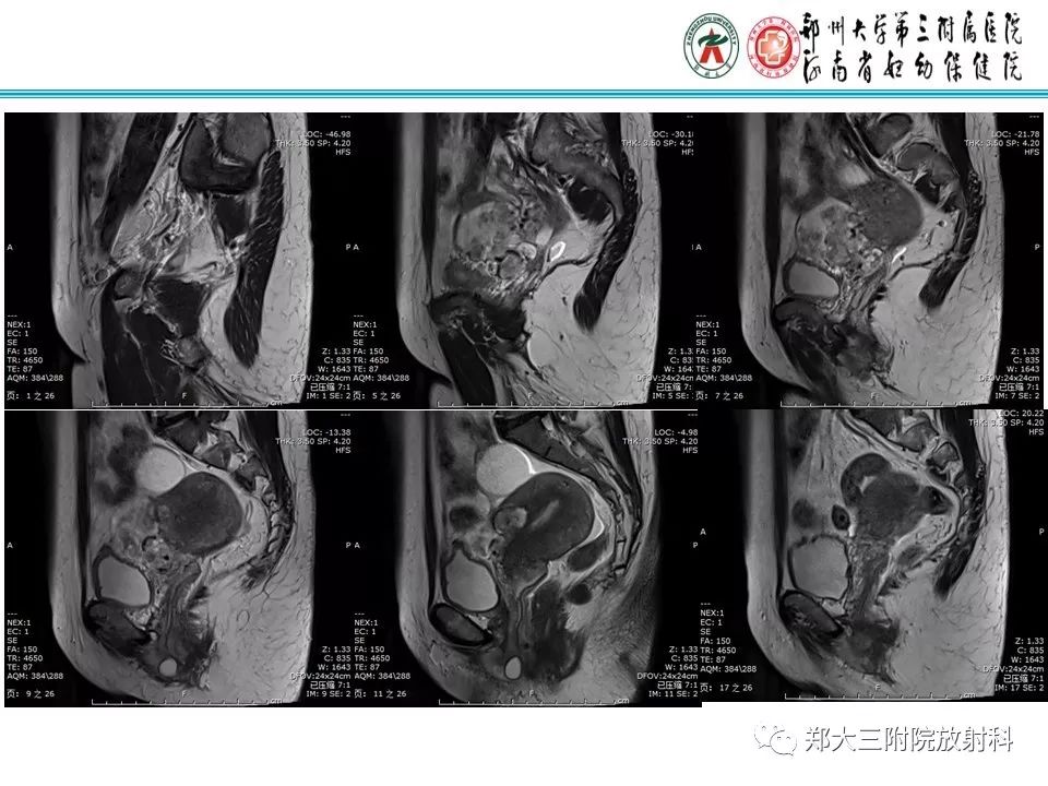 【病例】子宫静脉内平滑肌瘤病1例MR影像