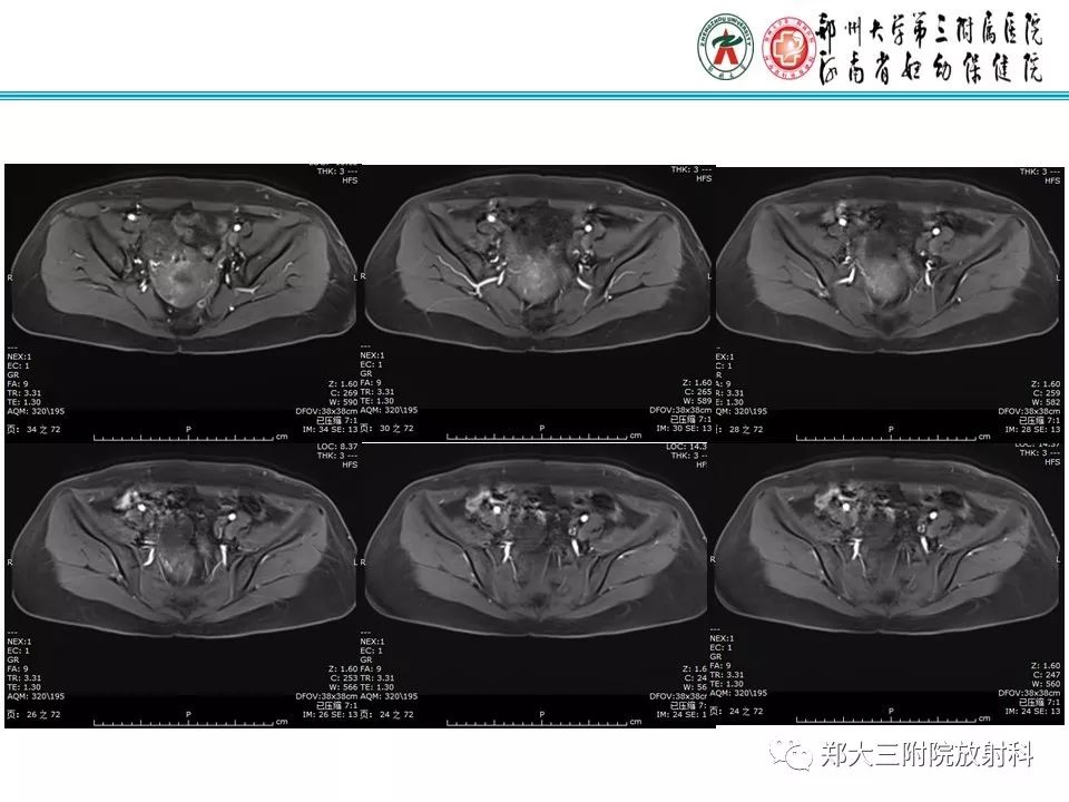 【病例】子宫静脉内平滑肌瘤病1例MR影像