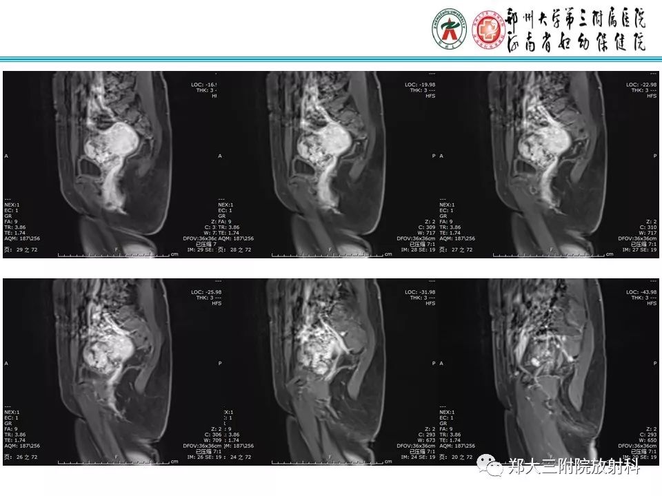 【病例】子宫静脉内平滑肌瘤病1例MR影像