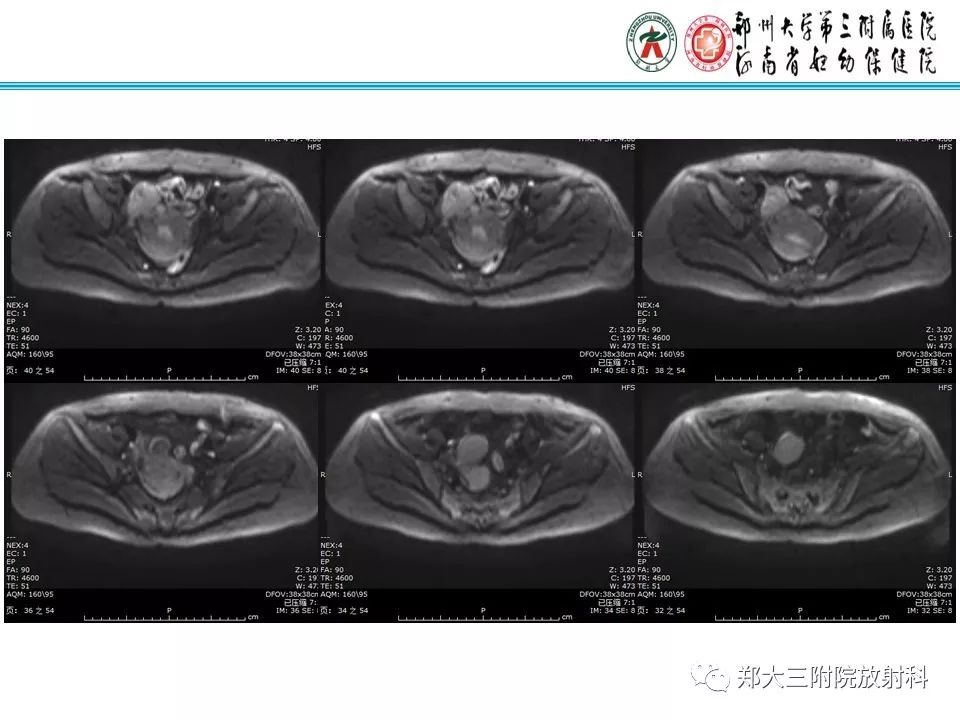 【病例】子宫静脉内平滑肌瘤病1例MR影像