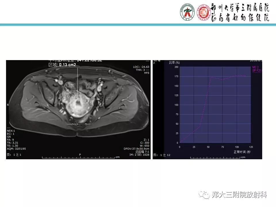 【病例】子宫静脉内平滑肌瘤病1例MR影像