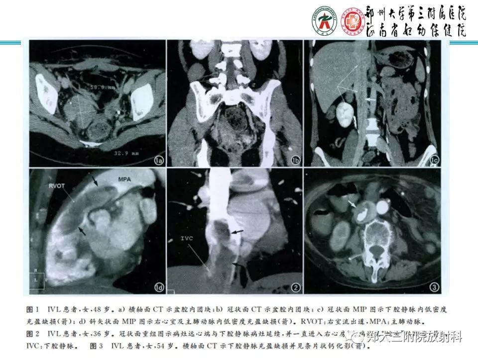【病例】子宫静脉内平滑肌瘤病1例MR影像