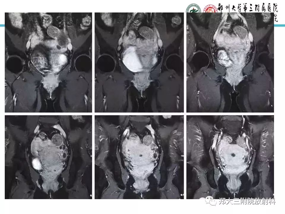 【病例】子宫静脉内平滑肌瘤病1例MR影像