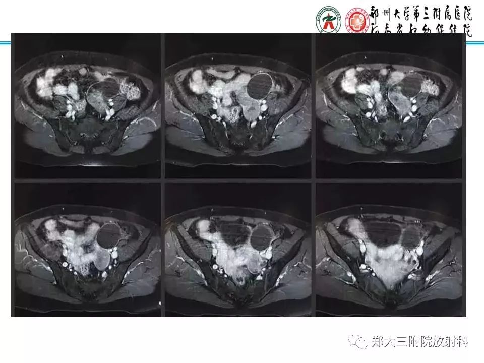 【病例】子宫静脉内平滑肌瘤病1例MR影像