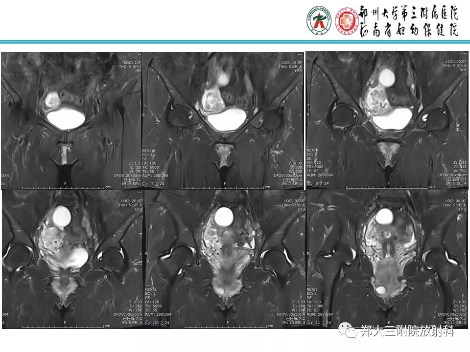 【病例】子宫静脉内平滑肌瘤病1例MR影像