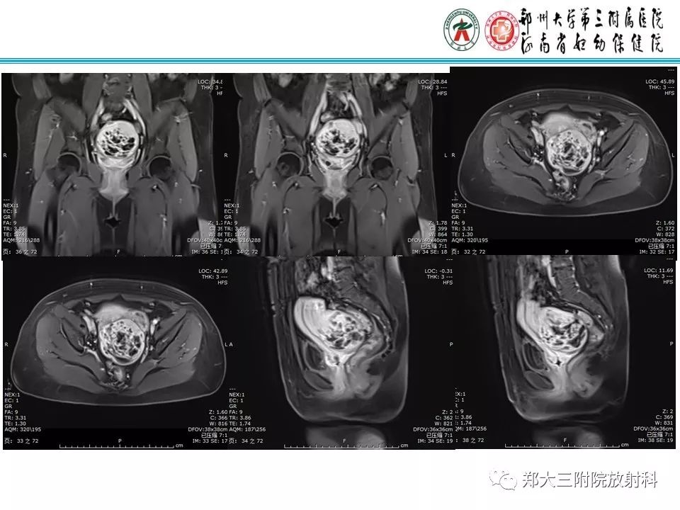 【病例】子宫静脉内平滑肌瘤病1例MR影像