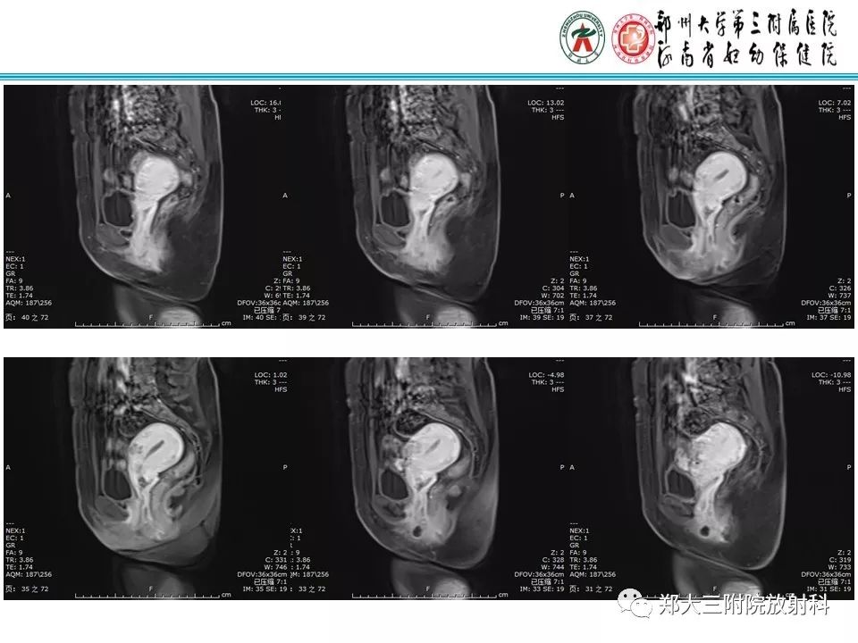【病例】子宫静脉内平滑肌瘤病1例MR影像
