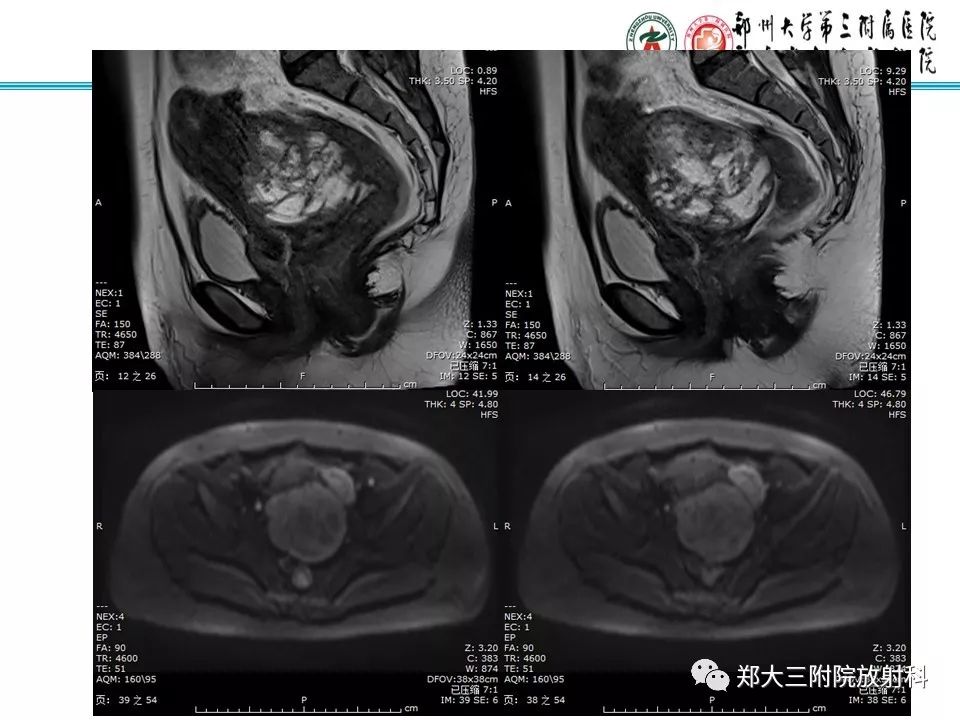 【病例】子宫静脉内平滑肌瘤病1例MR影像