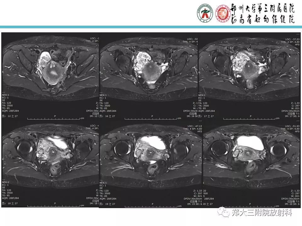 【病例】子宫静脉内平滑肌瘤病1例MR影像