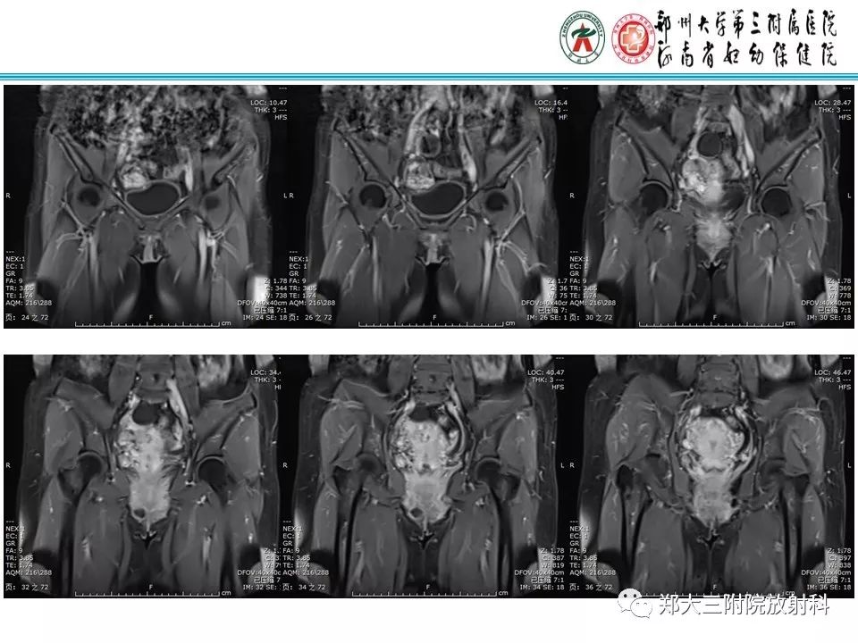 【病例】子宫静脉内平滑肌瘤病1例MR影像