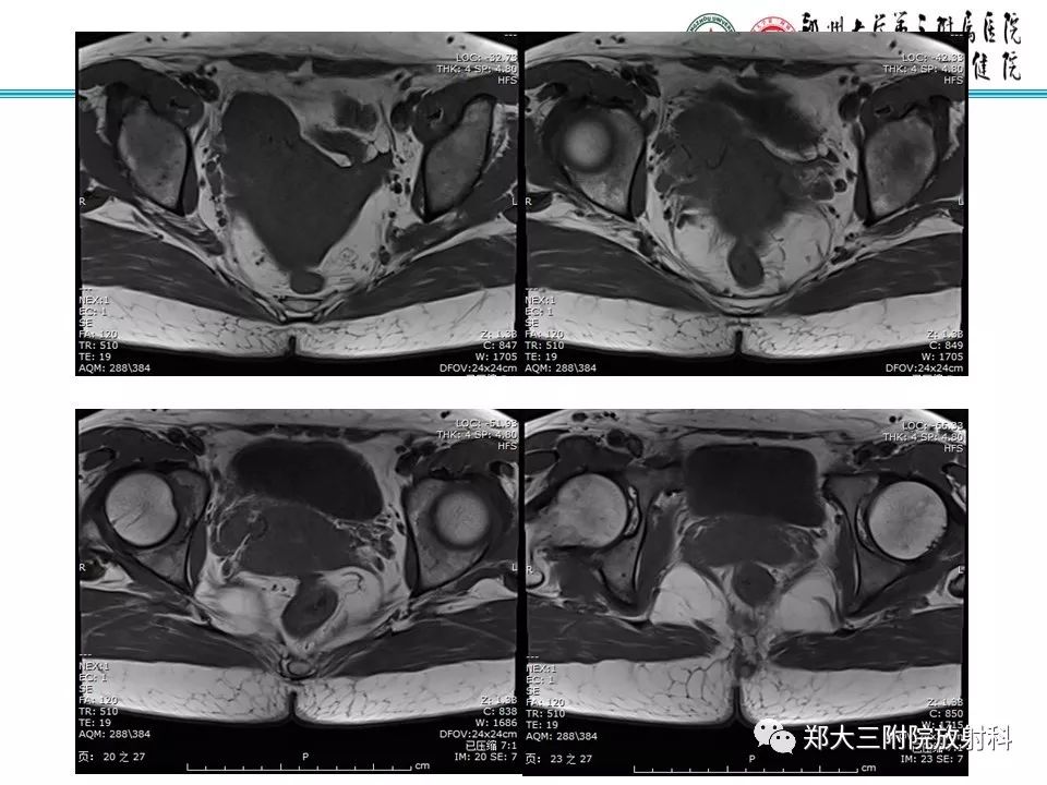 【病例】子宫静脉内平滑肌瘤病1例MR影像