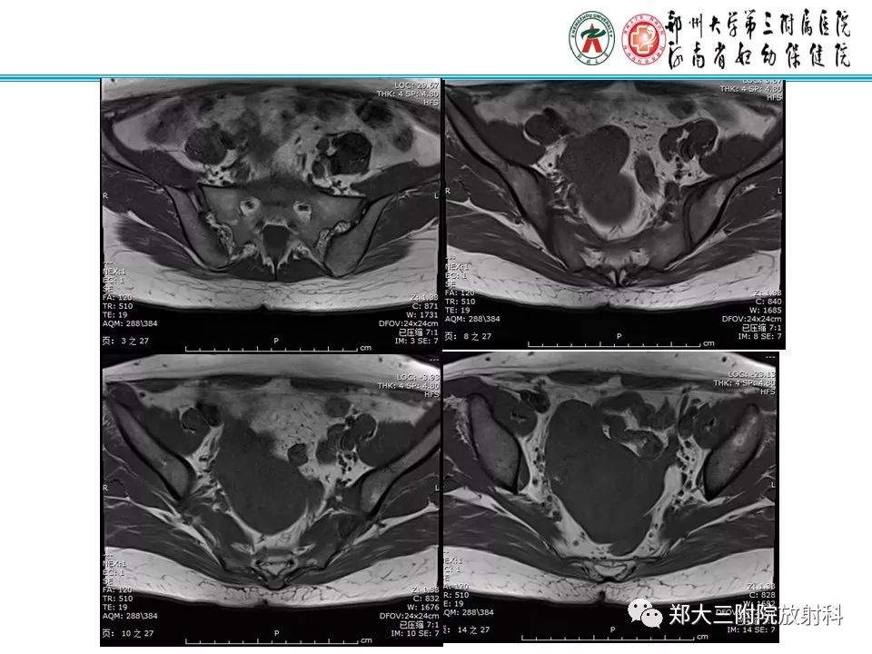 【病例】子宫静脉内平滑肌瘤病1例MR影像