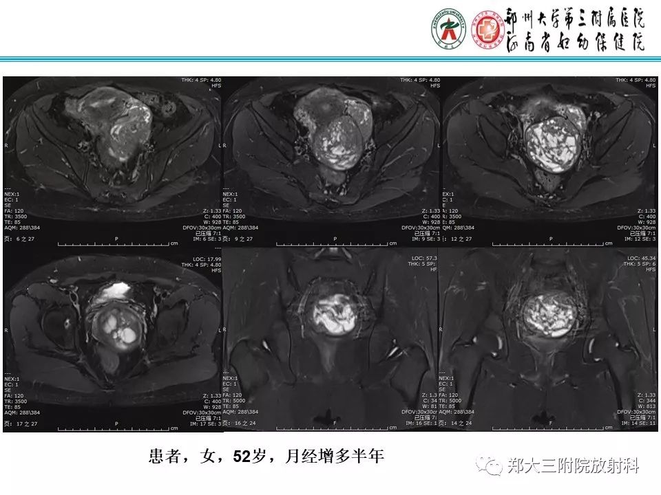 【病例】子宫静脉内平滑肌瘤病1例MR影像