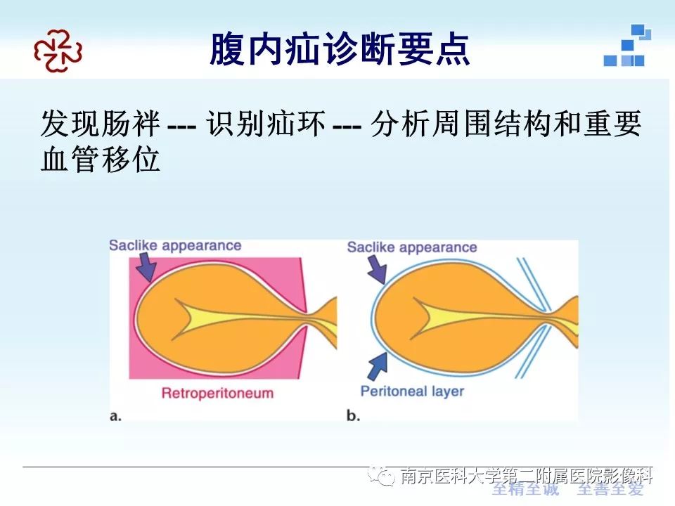 【PPT】腹内疝的CT表现