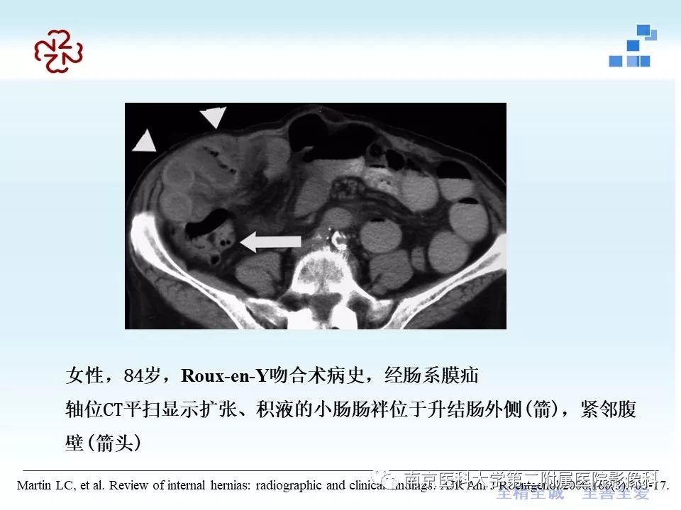 【PPT】腹内疝的CT表现