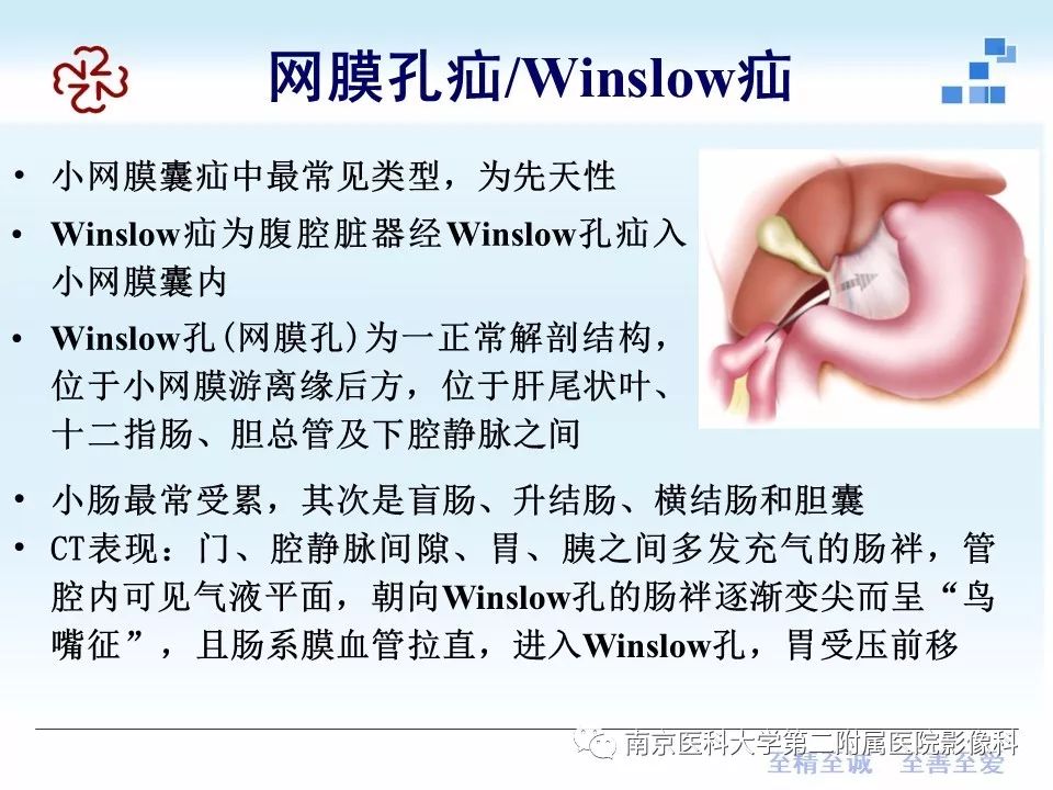 【PPT】腹内疝的CT表现