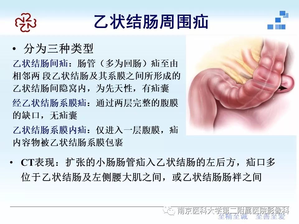 【PPT】腹内疝的CT表现